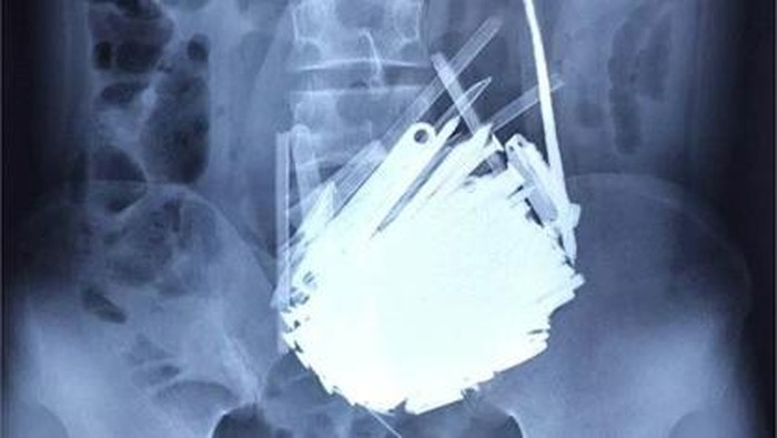 1764327980036-temuan-benda-asing-dalam-perut-pasien-1764223073535_169