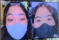 1768107946130-ptosis-penyebab-kelainan-mata-ngantuk_169